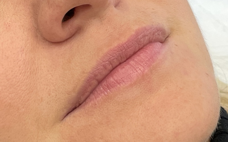 Фото до контурной пластики губ