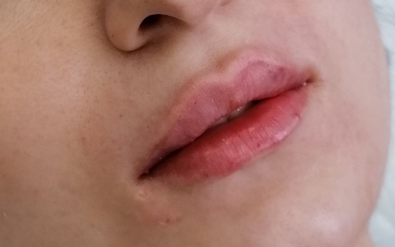 Фото после процедуры увеличения губ